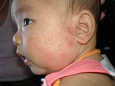 小儿过敏性湿疹 小儿过敏性湿疹是什么 患者可以用什么方法去治疗