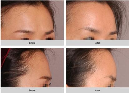 自体脂肪丰额头 自身脂肪丰额头手术 丰额的手术步骤是怎样的