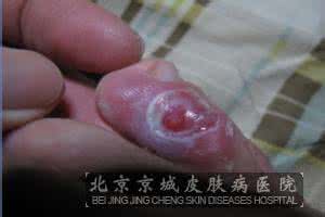 鸡眼的形成和治疗 鸡眼怎么形成的 鸡眼的治疗办法