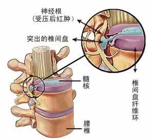 腰椎间盘突出症康复 腰椎间盘突出症，针对性后仰强健腰椎，巧妙修养促进髓核回纳。 一点资讯