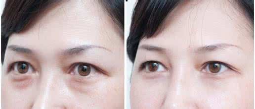 怎样消除眼袋小秘方 眼袋该怎样消除