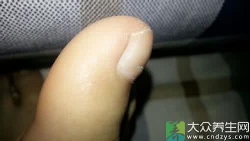 左脚大拇指麻木 左脚大拇指麻木 脚大拇指麻是怎么回事?