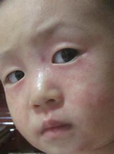 新生儿额头上有小红点 新生儿额头有小红点什么原因