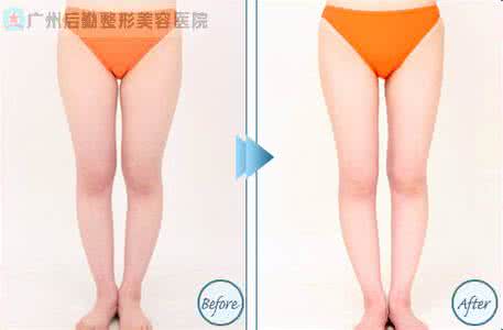 吸脂减肥有哪些方法 吸脂减肥方法 吸脂减肥有哪些方法