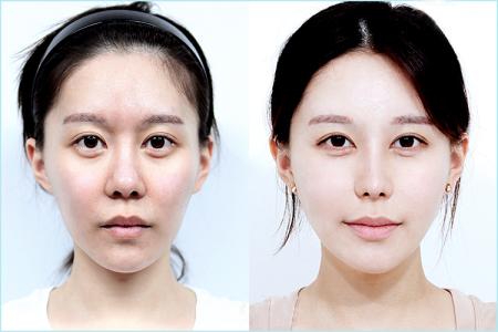 自体脂肪丰脸注意事项 自体脂肪丰太阳穴 自体脂肪丰太阳穴 术前术后注意事项有哪些