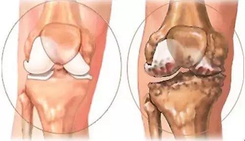 膝关节骨关节炎 膝关节骨关节炎（膝关节炎）
