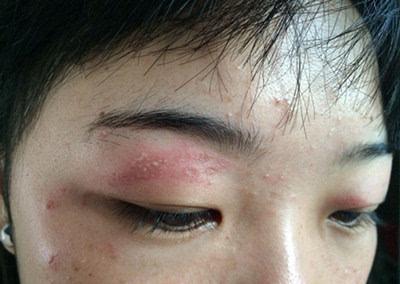 皮炎湿疹症状图片 皮炎湿疹症状 皮炎湿疹怎么判断？皮炎湿疹的症状