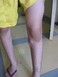 骨软骨瘤严重吗 骨软骨瘤 骨软骨瘤有什么症状