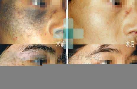 激光治疗太田痣的方法 激光治疗太田痣 激光治疗太田痣的突出特点