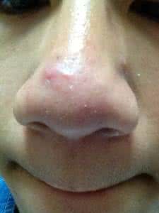 鼻子长痘痘的原因 鼻子长痘痘的原因 鼻子长痘痘能用碘伏吗？