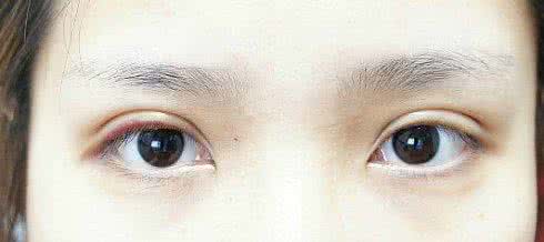 肿眼睛双眼皮埋线法 肿眼睛双眼皮埋线法 双眼皮单结连续埋线法