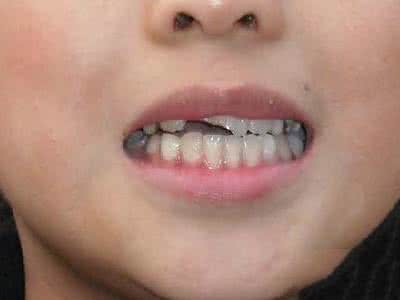 经常口腔溃疡会癌变吗 经常口腔溃疡会癌变吗 口腔溃疡分3大类型 溃疡形状或提示癌变