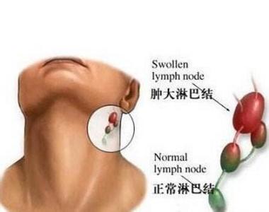 中医治疗淋巴结炎 颈部淋巴结炎 颈部淋巴结炎的症状与治疗