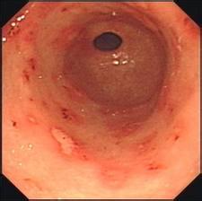 怎样治靡烂性胃炎 慢性靡烂性胃炎 三七粉能治胃靡烂吗？