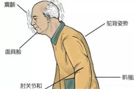 震颤麻痹的症状 震颤麻痹 它的症状有哪些