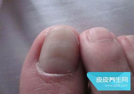 脚上鸡眼如何治疗 激光治疗脚鸡眼 脚上起鸡眼怎么办