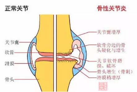 世界关节炎日 世界关节炎日 你有保护好自己的关节吗