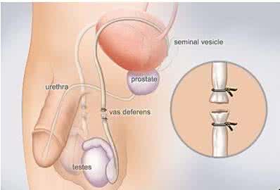 避孕的最佳方法 避孕方法有哪些