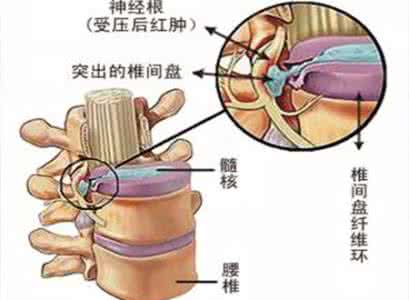 腰椎间盘突出高发人群 腰椎间盘突出如何治 三大类腰椎间盘突出的易患人群?