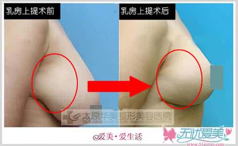 乳房下垂整形方法 乳房下垂整形的方法有哪些?