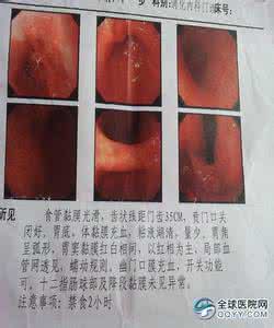 萎缩性胃炎 摩罗丹 胃病 萎缩性胃炎