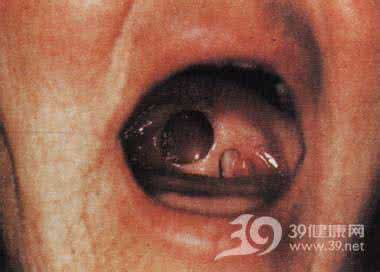 女性一期梅毒症状图片 梅毒的早期症状图片 一期梅毒图片