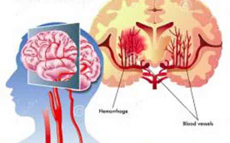 脑血栓的治疗方法 脑血栓治疗 正确治疗脑血栓