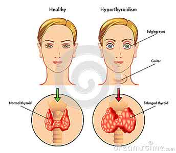 甲状腺机能亢进症状 甲状腺机能亢进 它有哪些发病原因