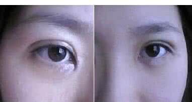 开眼角手术会留疤吗 开眼角手术会留疤吗 开眼角手术会留下疤吗?