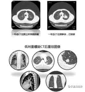 江苏万家灯火2017笔记 20160718万家灯火视频和笔记:洪专,低剂量螺旋CT,肺癌,食物防癌
