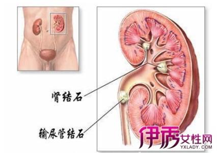 肾结石跟肾虚有关系吗 有肾结石的人会肾虚吗？