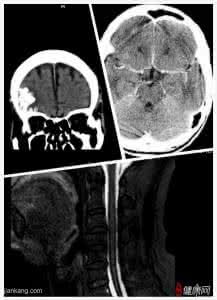 蛛网膜下腔出血治疗 蛛网膜下腔出血治疗 治疗这疾病的方法