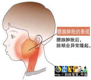 流行性腮腺炎临床表现 腮腺炎症状 腮腺炎有哪些临床表现