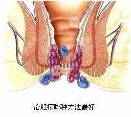 肛门瘙痒原因 肛门瘙痒 肛门瘙痒是什么原因