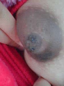 乳头干裂结痂容易剥掉 乳头黑色结痂能抠掉吗 乳头结痂是怎么回事？