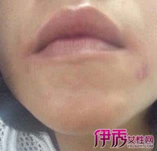 有什么好方法治疗疱疹 疱疹会传染么？怎样治疗好