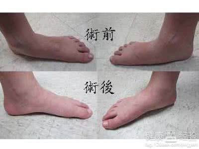孩子扁平足怎么办 你知道孩子是扁平足吗?