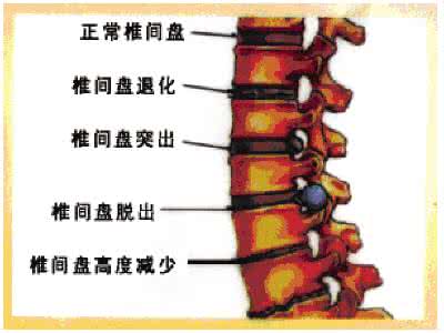 颈椎病发病趋势 颈椎病腰椎盘突出症发病呈年轻化趋势