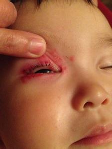 眼睛发炎 眼睛发炎15方