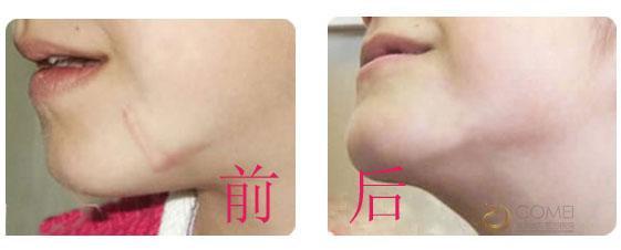 怎样修复疤痕 修复疤痕 疤痕应该怎样修复