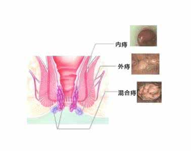 混合痔的治疗方法 混合痔怎么治 治疗混合痔的方法