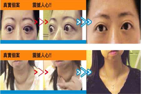 甲减和甲亢哪个严重 甲减和甲亢哪个严重 重度甲减严重会怎么样?