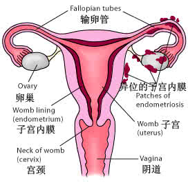 子宫内膜异位症的治疗 子宫内膜异位症的治疗 它的临床表现有哪些