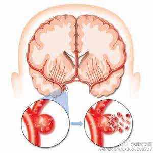脑出血和脑梗塞区别 预防脑梗、脑出血，牢记10个窍门