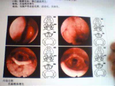 扁桃体肥大吃什么药 扁桃体肥大 扁桃体肥大，药贴“脚心”3次治愈