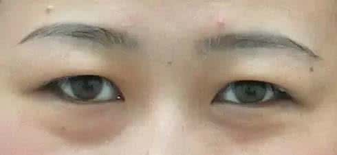 上眼皮下垂怎么恢复 小孩眼皮下垂 小孩眼皮下垂怎么回事呢?