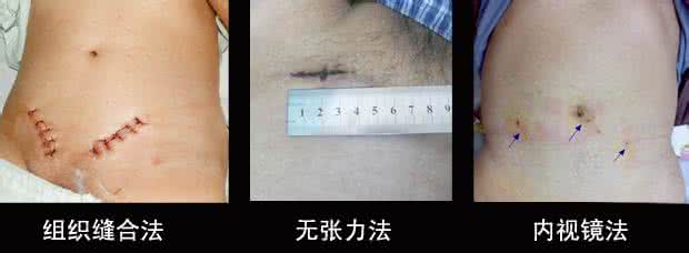 腹股沟疝气治疗方法 右腹疝气怎么治？三种方法最有效