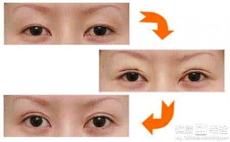 埋线双眼皮恢复过程图 埋线双眼皮恢复过程图 埋线双眼皮的恢复时间极短