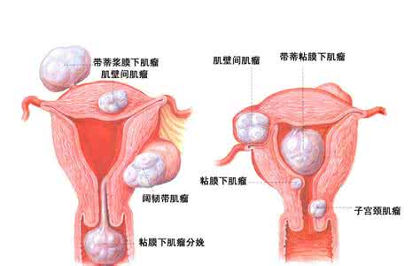 陰道出血是怎么治疗 治疗阴道炎有哪些方法