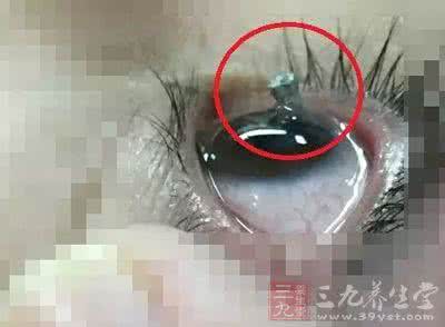 13根钉子一根支撑图 金华小伙眼睛被一根钉子扎入 惊奇的事情发生了